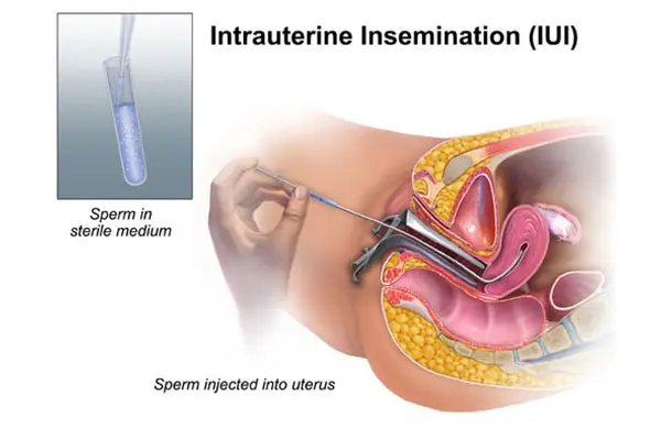 IUI (Intrauterine Insemination)