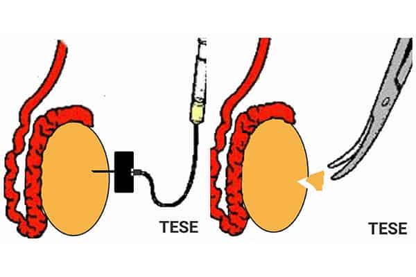 IVF Treatment with TESA and PESA