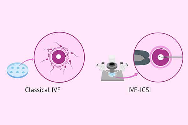 IVF with ICSI