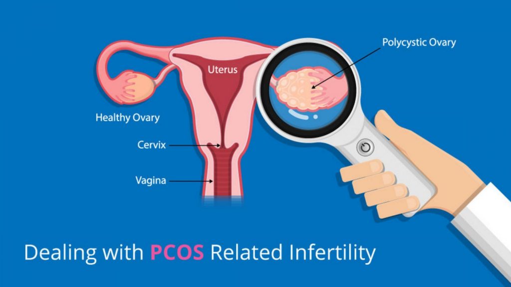 Polycystic Ovary Disease