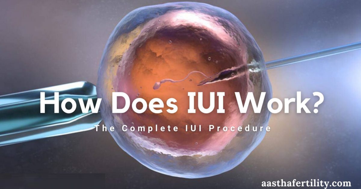 How Does IUI Work? The Complete IUI Procedure Step By Step
