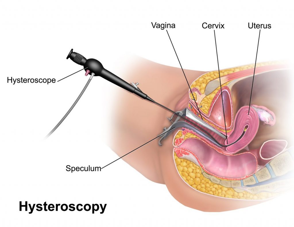 Hysteroscopy