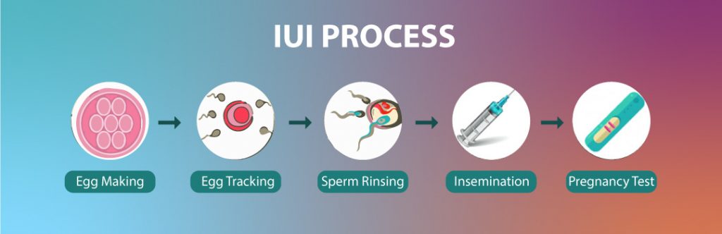 IUI process