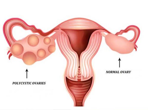 Normal VS PCOS uterus