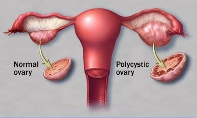 Normal ovary vs Polycystic ovary