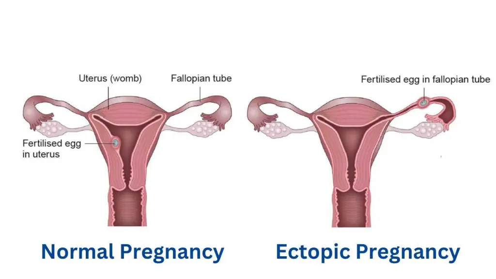 Normal Pregnancy VS Ectopic Pregnancy