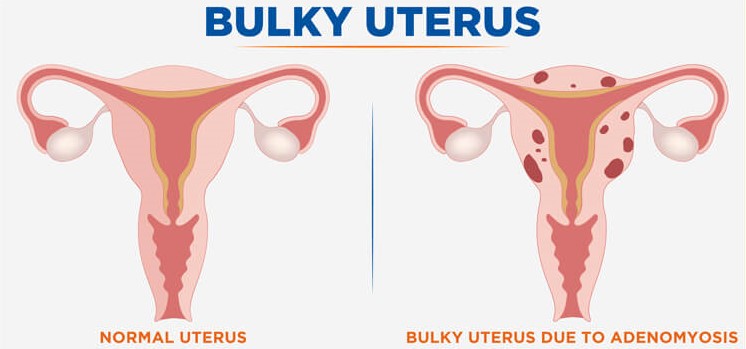 bulky uterus