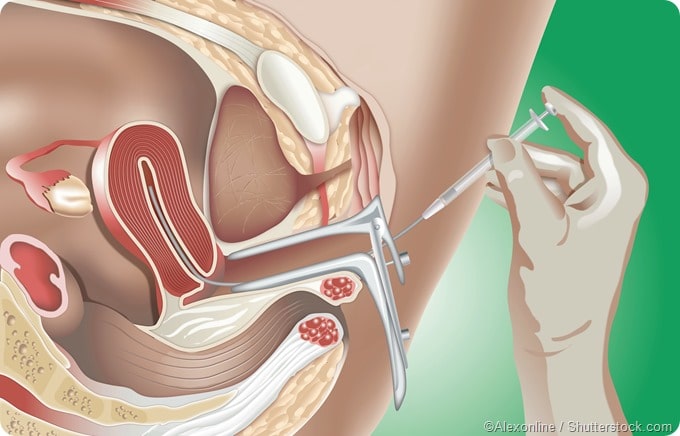 IUI Procedure