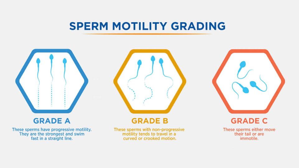 GRADE A' in blue: Sperm with progressive motility, swimming straight and strong.
'GRADE B' in yellow: Sperm with non-progressive motility, moving in curved paths.
'GRADE C' in red: Sperm that either wiggle their tails or remain immobile."