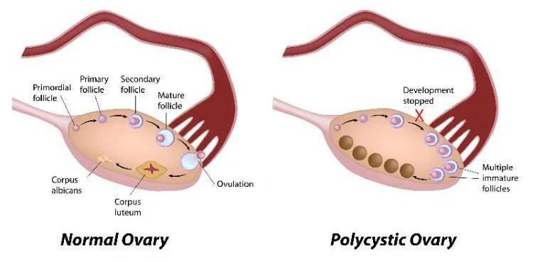 normal ovary vs polycystic ovary