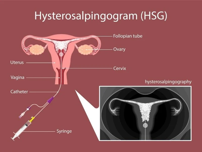 Hysterosalpingogram (HSG)