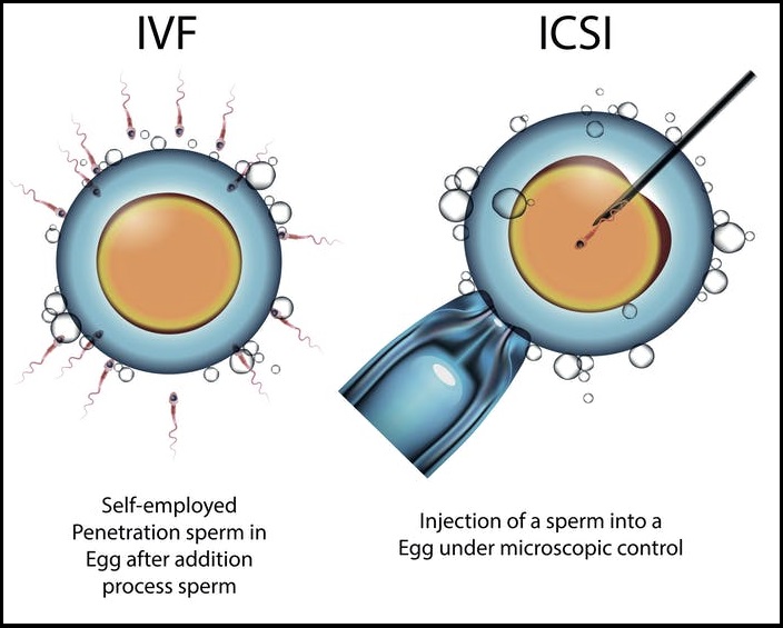 Intracytoplasmic Sperm Injection Vs. IVF