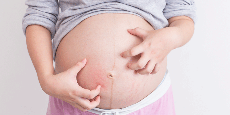 Cholestasis of Pregnancy