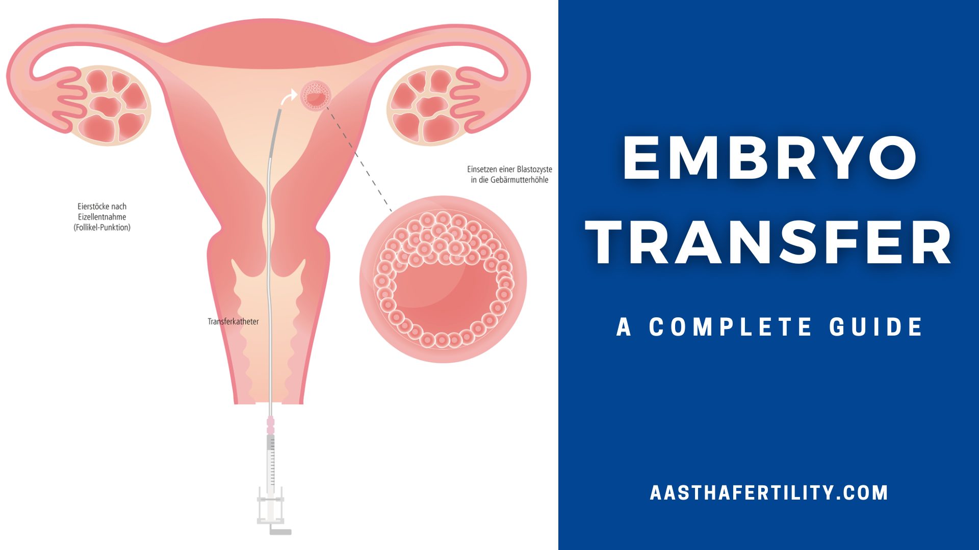 Embryo Transfer- A Complete Guide