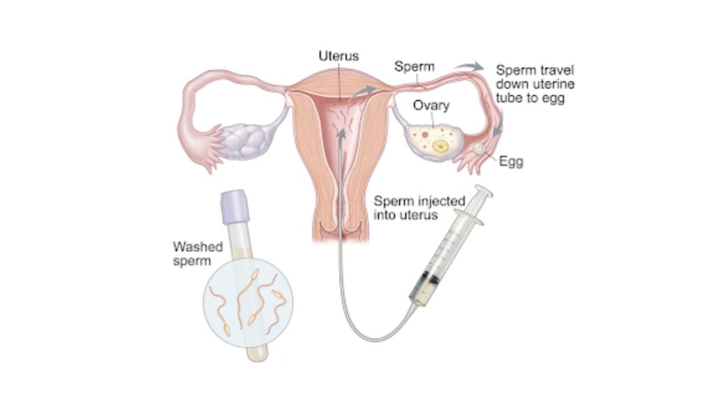 Step-by-Step Guide for IUI Process 