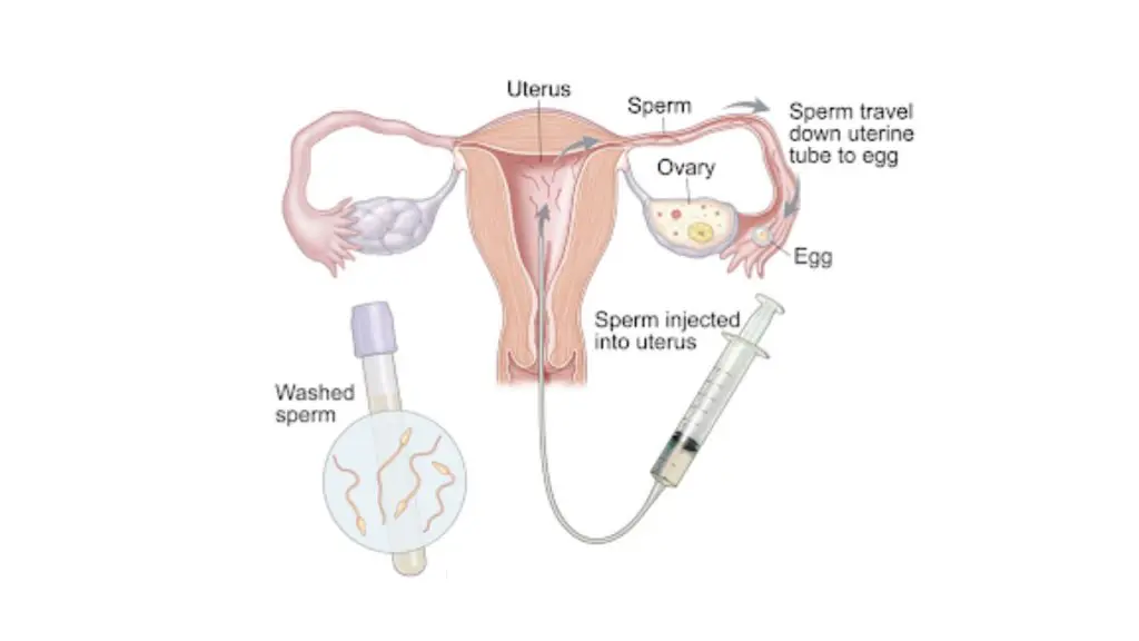 Step-by-Step Guide for IUI Process 