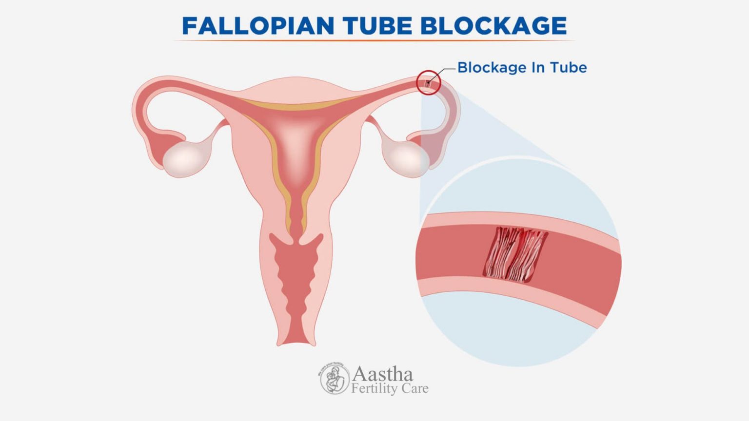 How To Get Pregnant Fast With One Fallopian Tube