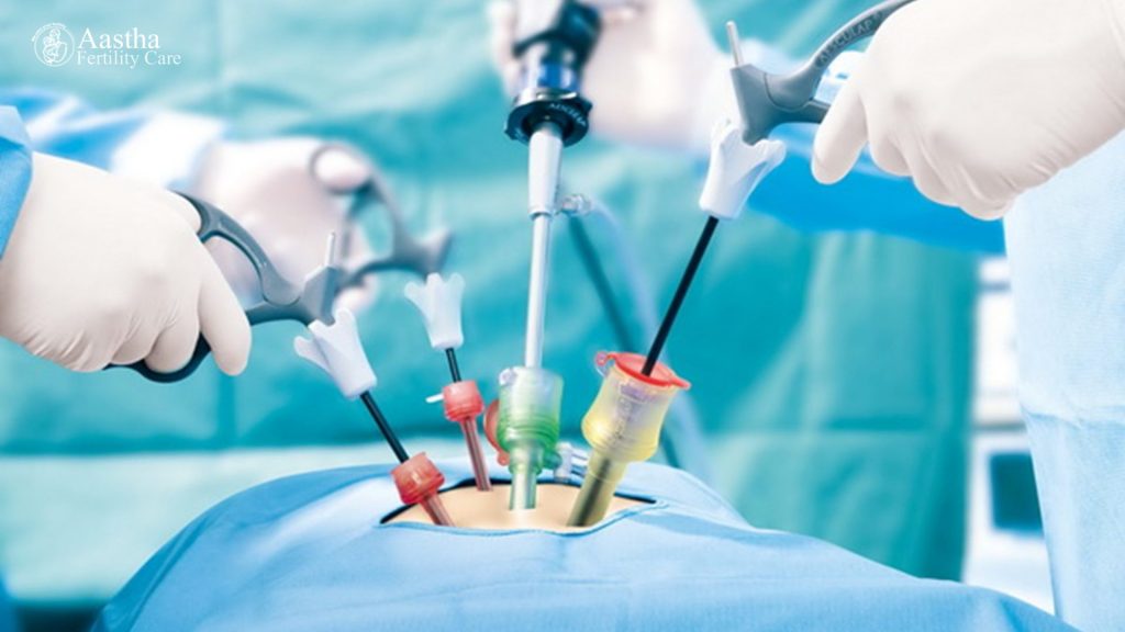 Laparoscopic Surgery for Blocked Fallopian Tubes
