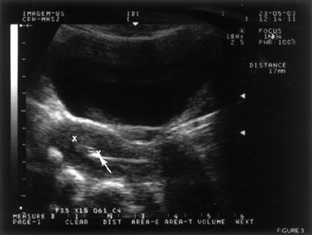 Day 3 - the blastocyst invades the uterine lining, and implantation commences.