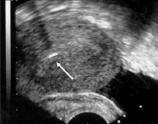 Day 4 - the blastocyst would continue to dig deeper into the uterus