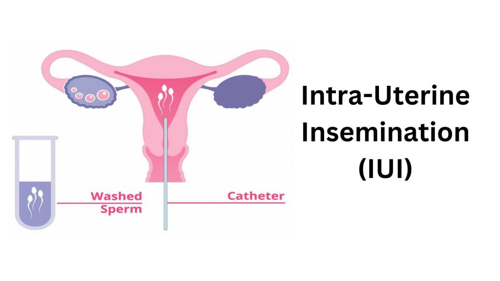 IUI (Intra-Uterine Insemination)