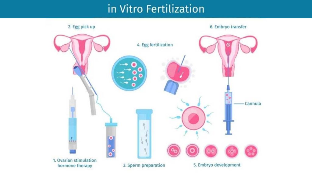 In Vitro Fertilization aka IVF