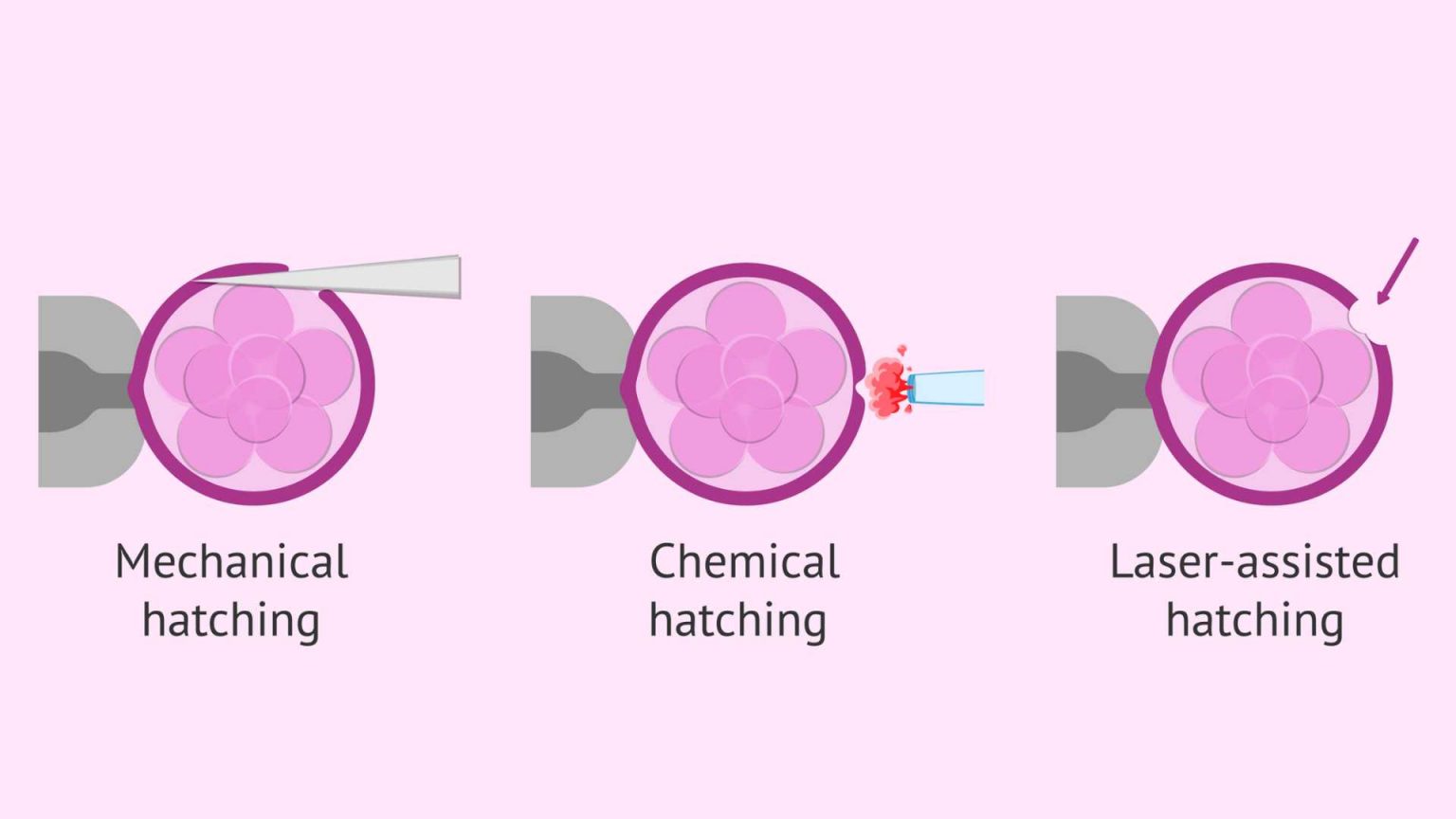 Types of IVF and their Procedures Aastha Fertility Center