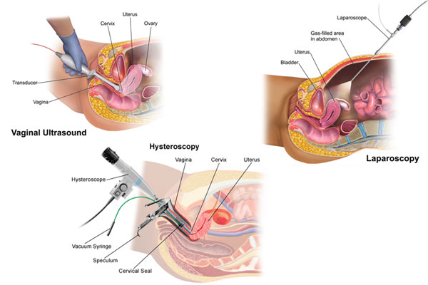 IVF treatment with TVS Hysteroscopy and laparoscopy technique