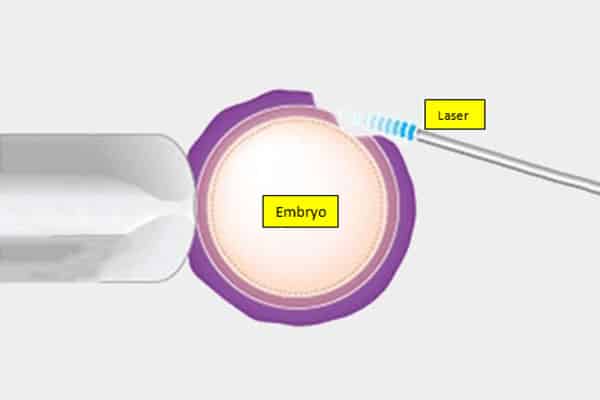 IVF with Laser Assisted Hatching