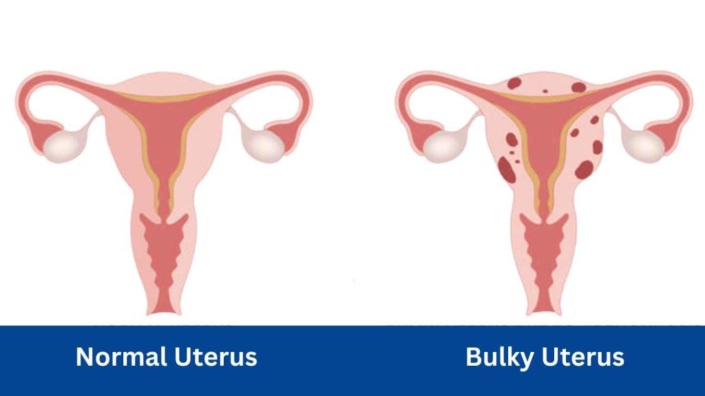 Normal Uterus VS Bulky Uterus