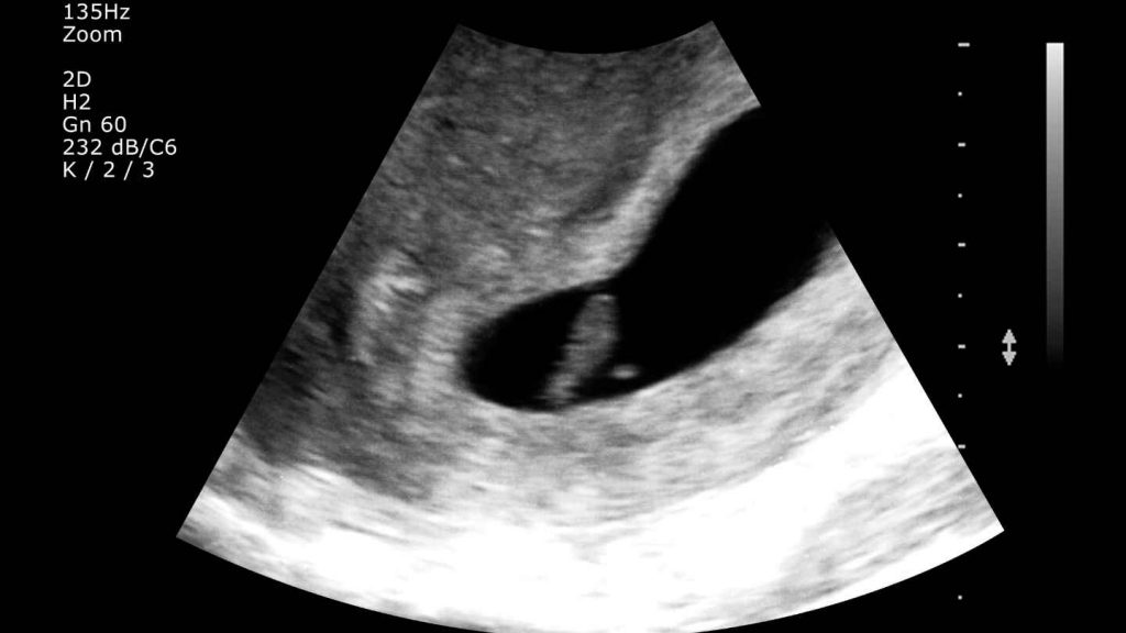First Month Ultrasound Report