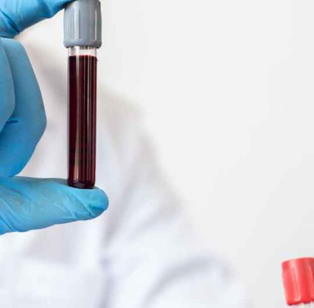 AMH Blood Test : Is it Accurate?