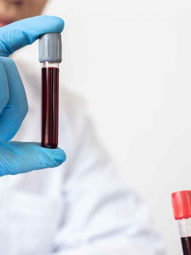 AMH Blood Test : Is it Accurate?