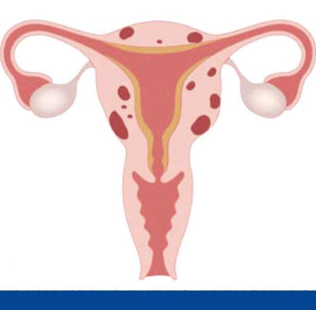 What is Bulky Uterus and Why Does It Occur?