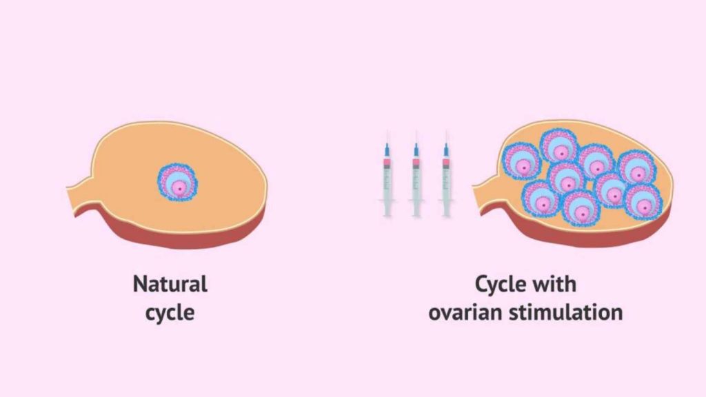 Natural Cycle Vs Cycle with Ovarian Stimulation