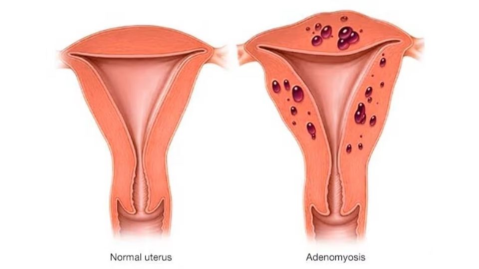 Normal Uterus Vs Adenomyosis