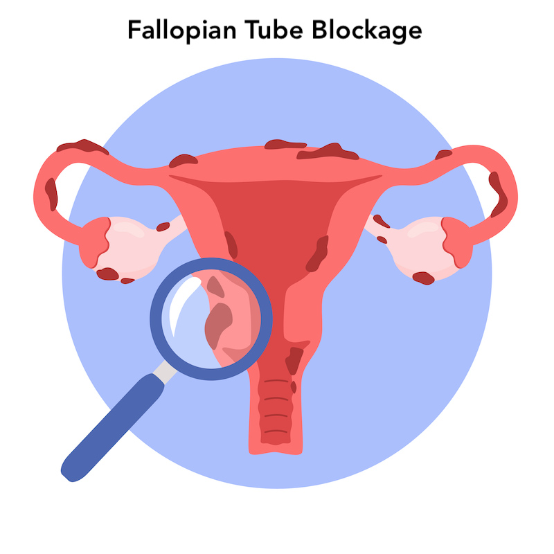 Fallopian Tube Blockage Treatment in Hindi