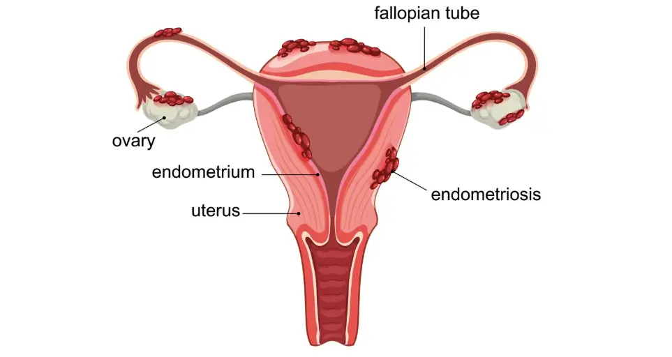 बच्चेदानी में सूजन होने से क्या परेशानी होती है?