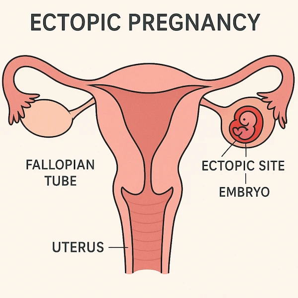 Ectopic Pregnancy Kya Hoti Hai- Ectopic Pregnancy Meaning In Hindi 