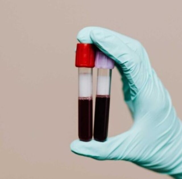 HSG Test for Fertility: Procedure, Benefits & What to Expect